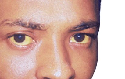 Hepatitis A Hepatitis A