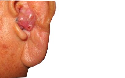 Tumor Telinga Tumor Telinga