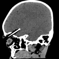 Pensil Masuk Rongga Bola Mata, si Balita Nyaris Meninggal Pensil Masuk Rongga Bola Mata, si Balita Nyaris Meninggal