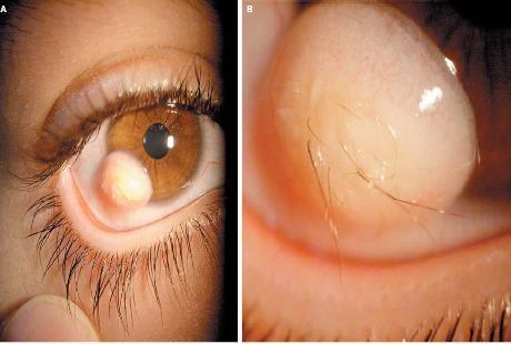 Seram! Tumbuh Rambut di Bola Mata Gara-gara Tumor Seram! Tumbuh Rambut di Bola Mata Gara-gara Tumor