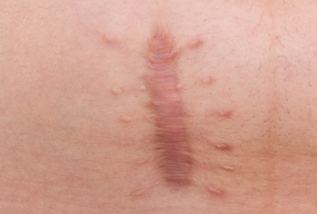 Apa Pantangan untuk Orang yang Punya Keloid? Apa Pantangan untuk Orang yang Punya Keloid?