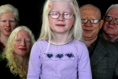 Menikah dengan Perempuan Albino, Apakah Anak Juga akan Albino? Menikah dengan Perempuan Albino, Apakah Anak Juga akan Albino?