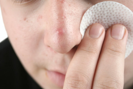 Jerawat Bernanah dan Susah Sembuh, Apakah Terkena Acne Vulgaris? Jerawat Bernanah dan Susah Sembuh, Apakah Terkena Acne Vulgaris?