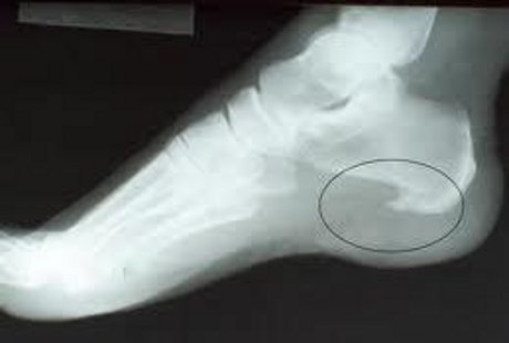 Ada Gambar Jalu Ayam di Foto Rontgen Kaki, Apa Artinya? Ada Gambar Jalu Ayam di Foto Rontgen Kaki, Apa Artinya?